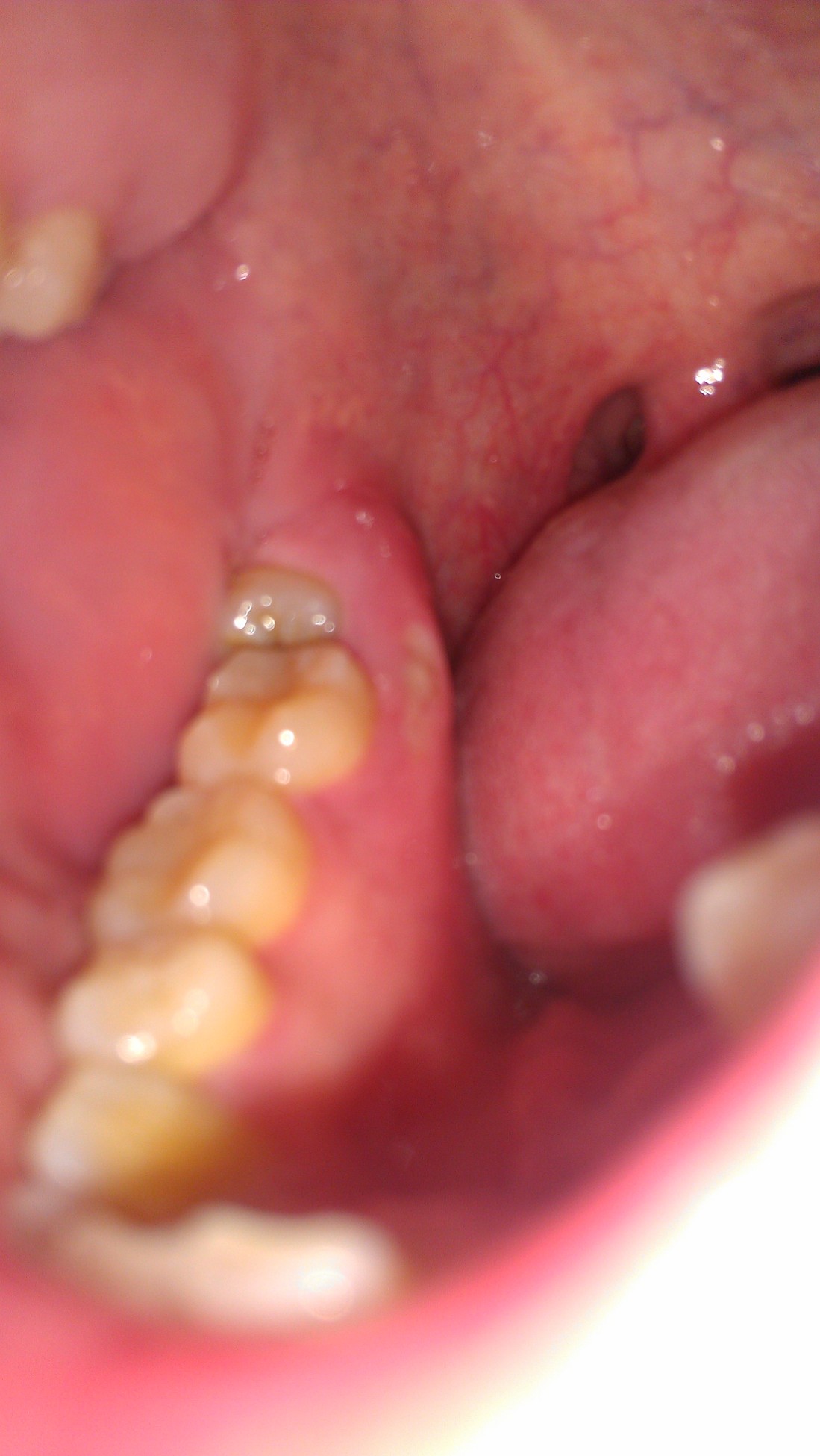 hard-lump-on-gum-after-tooth-extraction