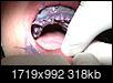 Twenty-four Dental Implants & individual Crowns-img_1471_cropped.jpg