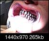 Twenty-four Dental Implants & individual Crowns-img_1493_cropped.jpg