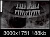 Twenty-four Dental Implants & individual Crowns-_20121218_12154007_cropped.jpg
