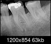 Occasional pain in molar with a lot of fillings-should I try clove oil?-18-molar-10-1-19.jpg