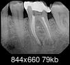 Occasional pain in molar with a lot of fillings-should I try clove oil?-18-molar-r.c.jpg
