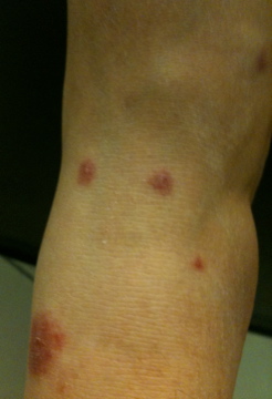 What bug can bite multiple times only one night?! (Photos) (ankle ...