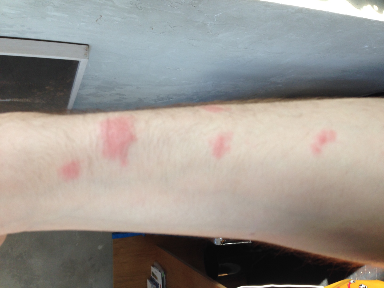 Are These Bed Bug Bites Allergy Skin Blood Swelling Health And Images