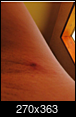 Pain under armpit, found a tick while shaving-screen-shot-2019-05-04-10.40.50