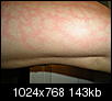 I just got this rash....we were by the fire outside....spider was on my leg.....Please help?-dscn0005.jpg