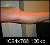 I just got this rash....we were by the fire outside....spider was on my leg.....Please help?-dscn0007.jpg