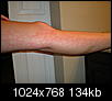 I just got this rash....we were by the fire outside....spider was on my leg.....Please help?-dscn0008.jpg