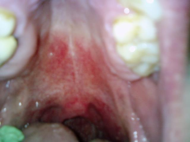 Red Spots In Throat 20