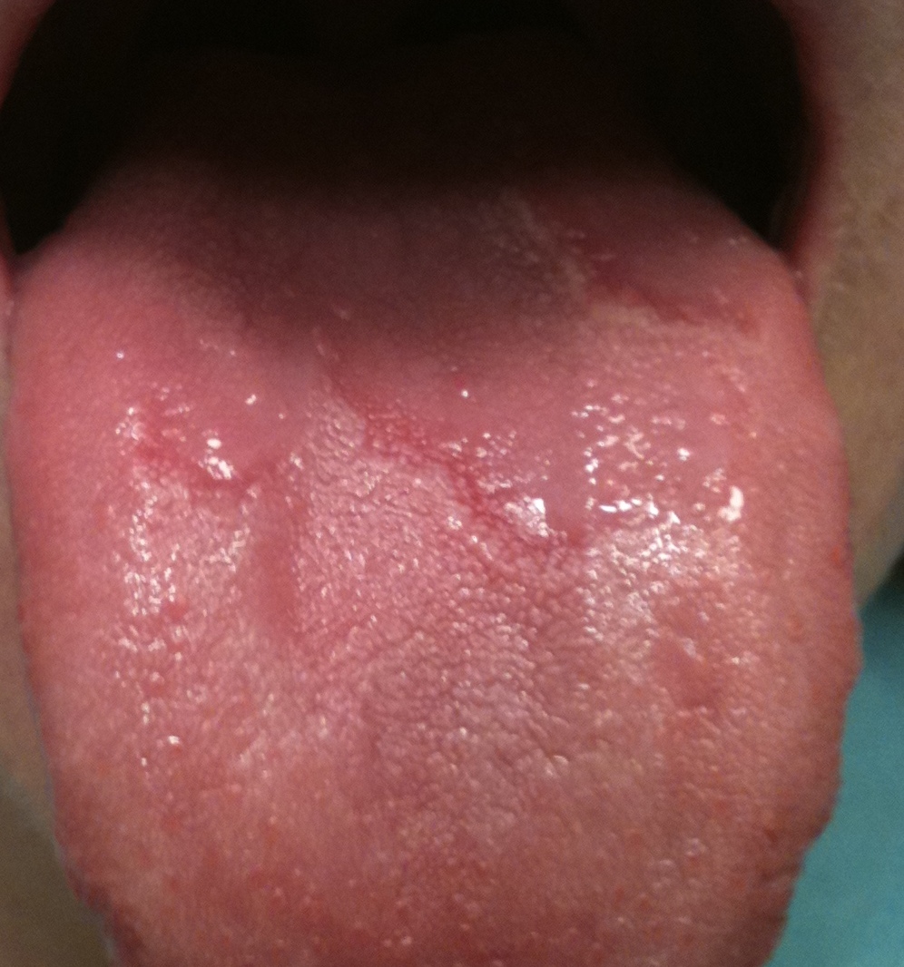 Blisters In Back Of Mouth 31