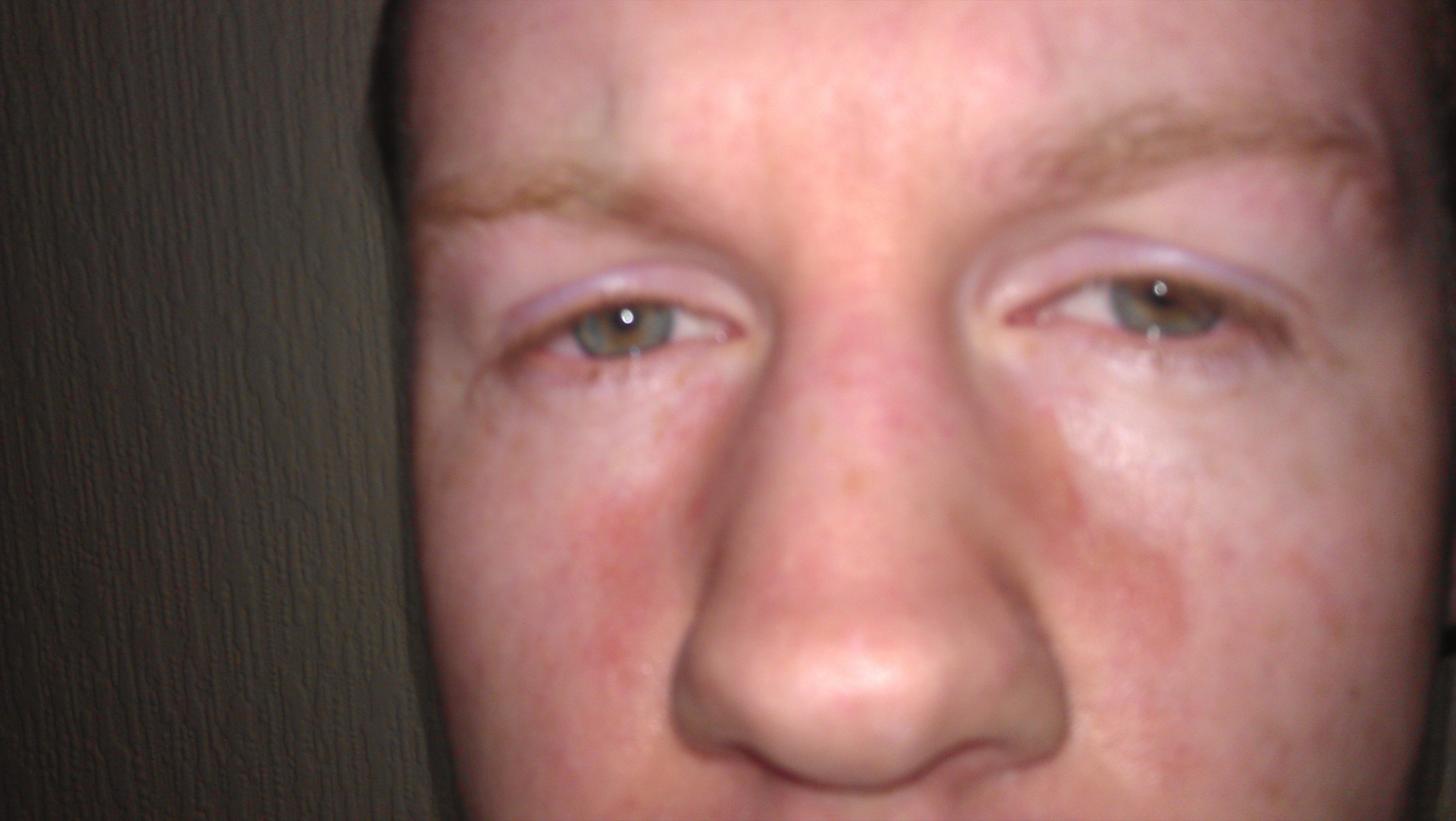 Skin Rash Under the Eye: Signs, Symptoms and Treatments
