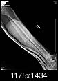 Fractured Tibia and Fibula (Broken Lower Leg Bones) with Fixation Surgery (Part 2)-1.2.840.113564.10.1.65470435141043170911339561210162532071.jpg