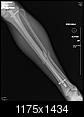 Fractured Tibia and Fibula (Broken Lower Leg Bones) with Fixation Surgery (Part 2)-1.2.840.113564.10.1.3382279264193391942113698211522414351124.jpg