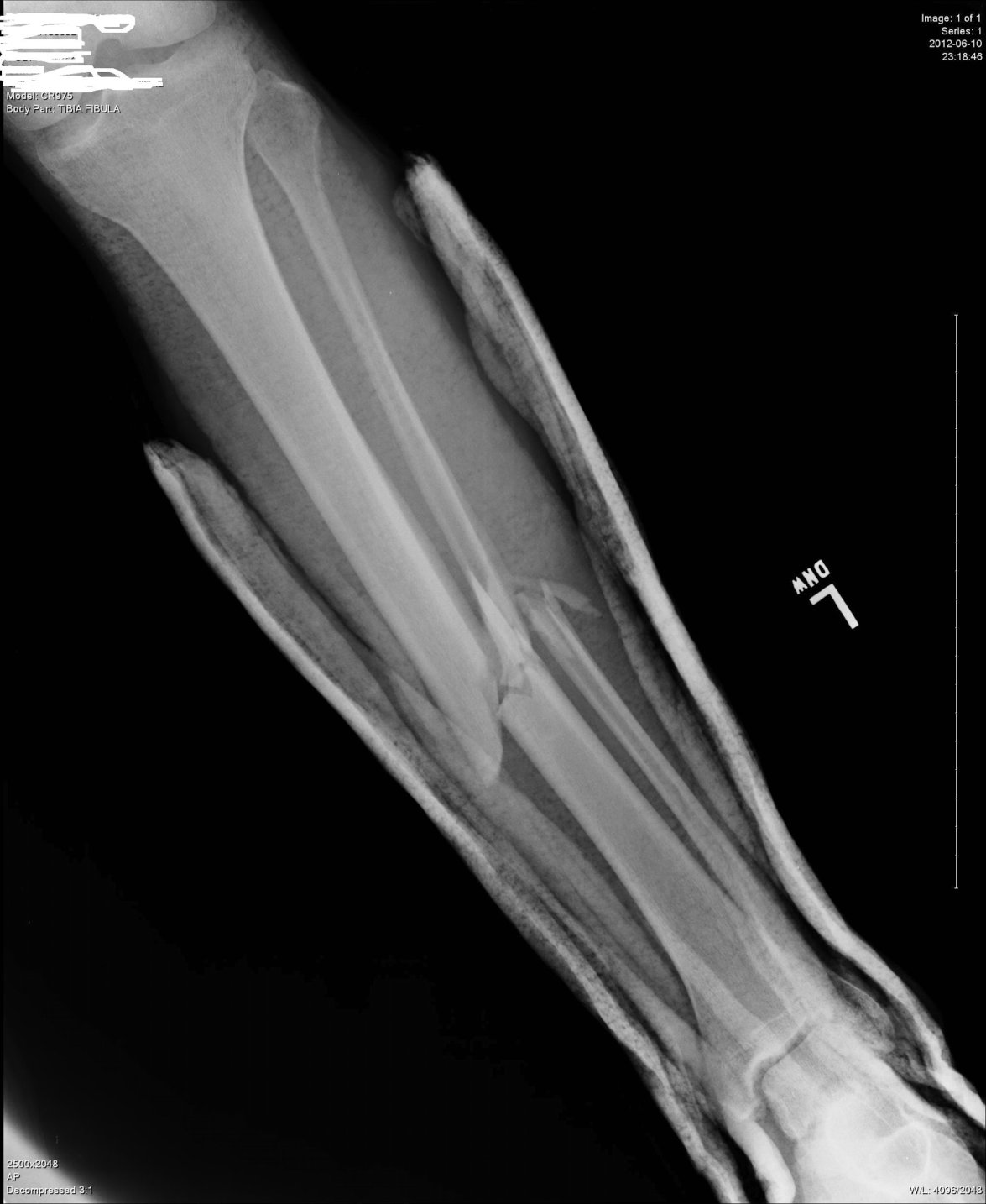 Fractured Tibia and Fibula (Broken Lower Leg Bones) with ...