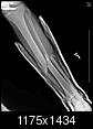 Fractured Tibia and Fibula (Broken Lower Leg Bones) with Fixation Surgery (Part 2)-1.2.840.113564.10.1.3437409150497418389137120362814523207106.jpg