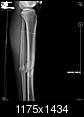 Fractured Tibia and Fibula (Broken Lower Leg Bones) with Fixation Surgery (Part 2)-1.2.840.113564.10.1.15601561715667720264166194255581192471457.jpg