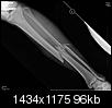 Fractured Tibia and Fibula (Broken Lower Leg Bones) with Fixation Surgery (Part 2)-1.2.840.113564.10.1.28637092481209016825161141511802425109118.jpg