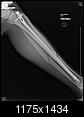 Fractured Tibia and Fibula (Broken Lower Leg Bones) with Fixation Surgery (Part 2)-1.2.840.113564.10.1.29907565642644119345135210129226230116170129.jpg