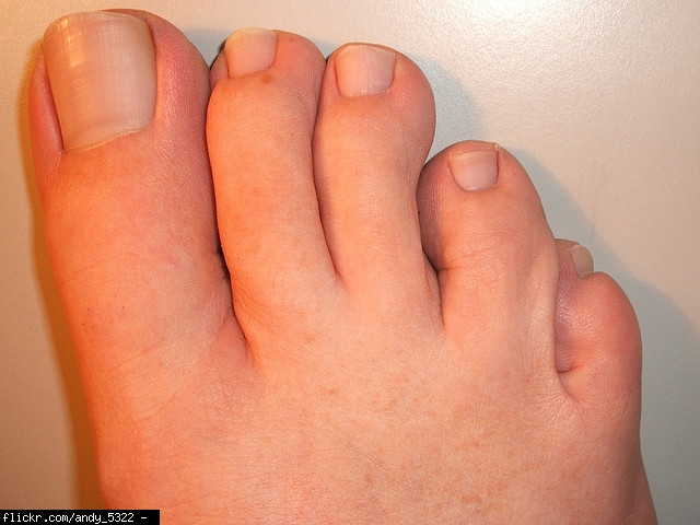toenail melanoma picture #10