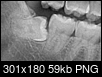 Wisdom Tooth Residual not extracted-x-ray-1.png
