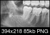 Wisdom Tooth Residual not extracted-x-ray2.png