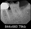 Back molar--#18--is infected & nerve exposed. Also was previously damaged.  Extraction? Or root canal & crown-18-19-teeth-4-11-2022.jpg