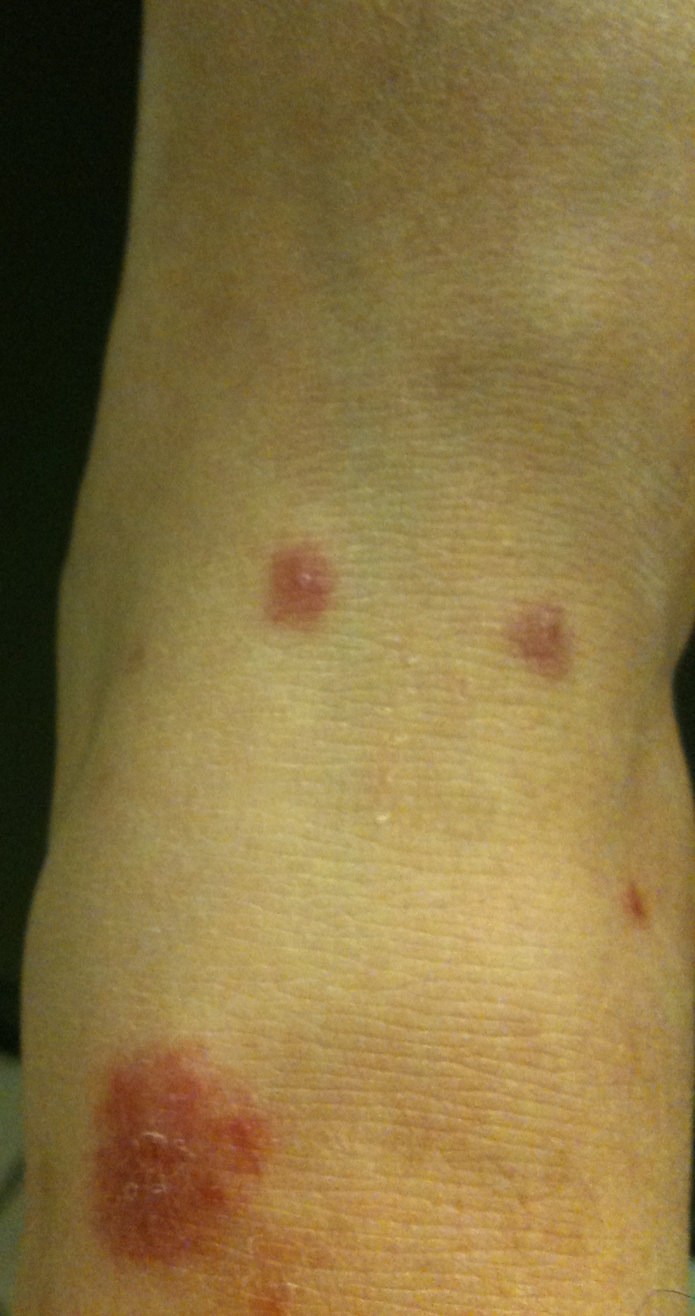 What Bug Can Bite Multiple Times Only One Night Photos Ankle