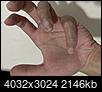 Raised White Line Scar on Pinky Finger From Luggage Zipper Injury?-img_3363.jpg