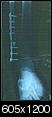Fractured Tibia and Fibula (Broken Lower Leg Bones) with Fixation Surgery-xray.jpg