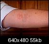 Guess that rash!-photo-129.jpg