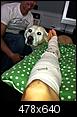Fractured Tibia and Fibula (Broken Lower Leg Bones) with Fixation Surgery (Part 2)-screws.jpg