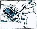 This picture if very graphic. It shows how they do a partial birth abortion. They inject the baby's brain with salin, and let it die