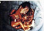 salt abortion1 9wk 
The procidure is done by injecting salin water into the uterus after amniontic fuid has been removed
