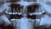 panoramic x-ray of my teeth