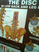 The Disc Low Back Leg Pain